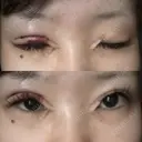 目頭切開 / 眼瞼下垂（切開） サラ美容外科 DAY 1 サムネイル用