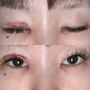 目頭切開 / 眼瞼下垂（切開） サラ美容外科 DAY 2 サムネイル用