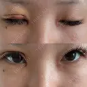 目頭切開 / 眼瞼下垂（切開） サラ美容外科 DAY 3 サムネイル用