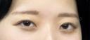 二重埋没 / その他（目元） LUHO（ルホ）美容外科 DAY 31 サムネイル用