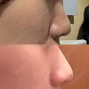 ヒアルロン酸注入（涙袋） / シワ取りボトックス / ヒアルロン酸注入（鼻翼基部） 東京シルククリニック 東京神田院 DAY 0 サムネイル用