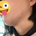 二重埋没 / 目頭切開 / 糸リフト / クマ治療 / 脂肪吸引（顔） / 上まぶたの脂肪取り / ジョールファット除去 ルラ美容クリニック 渋谷本院 DAY 40 サムネイル用