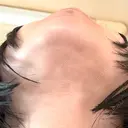 二重埋没 / 目頭切開 / 糸リフト / クマ治療 / 脂肪吸引（顔） / 上まぶたの脂肪取り / ジョールファット除去 ルラ美容クリニック 渋谷本院 DAY 40 サムネイル用