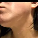 二重埋没 / 目頭切開 / 糸リフト / クマ治療 / 脂肪吸引（顔） / 上まぶたの脂肪取り / ジョールファット除去 ルラ美容クリニック 渋谷本院 DAY 41 サムネイル用