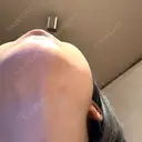 二重埋没 / 目頭切開 / 糸リフト / クマ治療 / 脂肪吸引（顔） / 上まぶたの脂肪取り / ジョールファット除去 ルラ美容クリニック 渋谷本院 DAY 41 サムネイル用