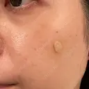 ピコスポット Fellez Clinic【フェルズクリニック】 DAY 8 サムネイル用