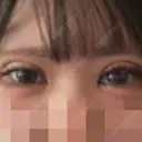 二重埋没 / ヒアルロン酸注入（涙袋） アリエル美容クリニック 郡山院 DAY 0 サムネイル用