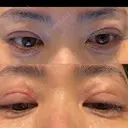 二重埋没 KIMI CLINIC 形成・美容外科 AFTER サムネイル用