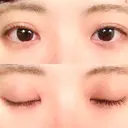 二重埋没 / 上まぶたの脂肪取り 東京ヒルズクリニック 新宿院 DAY 33 サムネイル用