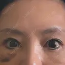 眉下切開 MOMO CLINIC DAY 8 サムネイル用