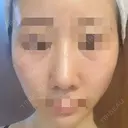 鼻尖形成（切開） / 鼻中隔延長（切開） / 軟骨移植 / 骨切幅寄せ / ワシ鼻修正・ハンプ切除 / 斜鼻修正 / 鼻修正 リッツ美容外科 東京院 AFTER サムネイル用