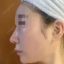 鼻尖形成（切開） / 鼻中隔延長（切開） / 軟骨移植 / 骨切幅寄せ / ワシ鼻修正・ハンプ切除 / 斜鼻修正 / 鼻修正 リッツ美容外科 東京院 DAY 37 サムネイル用