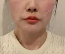 脂肪吸引（顔） THE CLINIC（ザ・クリニック） 大阪院 DAY 25 サムネイル用