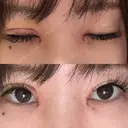 目頭切開 / 眼瞼下垂（切開） サラ美容外科 DAY 4 サムネイル用
