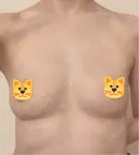 豊胸（脂肪注入） / 脂肪注入（額） / 乳頭縮小 アールクリニック DAY 31 サムネイル用