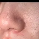 毛穴洗浄（ハイドラフェイシャルなど） 心斎橋KT美容クリニック AFTER サムネイル用