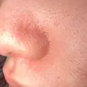 毛穴洗浄（ハイドラフェイシャルなど） 心斎橋KT美容クリニック DAY 1 サムネイル用