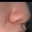 毛穴洗浄（ハイドラフェイシャルなど） 心斎橋KT美容クリニック DAY 1 サムネイル用