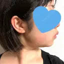 脂肪吸引（顔） GRACIA clinic 【グラシアクリニック】 DAY 22 サムネイル用