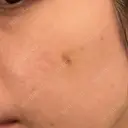 ピコスポット Fellez Clinic【フェルズクリニック】 DAY 11 サムネイル用