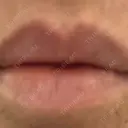 ヒアルロン酸注入（唇） / ボトックス（眉間） / ボトックス（目尻） / ボトックス（額） TCB東京中央美容外科 自由が丘院 DAY 1 サムネイル用