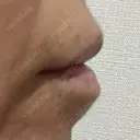 ヒアルロン酸注入（唇） / ボトックス（眉間） / ボトックス（目尻） / ボトックス（額） TCB東京中央美容外科 自由が丘院 DAY 2 サムネイル用