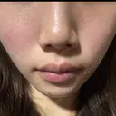 フォトRF 湘南美容クリニック 長野院 DAY 0 サムネイル用