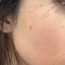 ルメッカ おおかみ美容のクリニック 新宿院 DAY 1 サムネイル用