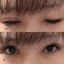 目頭切開 / 眼瞼下垂（切開） サラ美容外科 DAY 6 サムネイル用