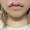 ヒアルロン酸注入（唇） / ボトックス（口角） PRO CLINIC プロクリニック 銀座院 DAY 1 サムネイル用