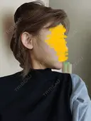 糸リフト / 脂肪吸引（顔） / ジョールファット除去 RIVER CLINIC（リバークリニック） DAY 3 サムネイル用