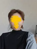 糸リフト / 脂肪吸引（顔） / ジョールファット除去 RIVER CLINIC（リバークリニック） DAY 3 サムネイル用