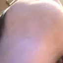 二重埋没 / 目頭切開 / 糸リフト / クマ治療 / 脂肪吸引（顔） / 上まぶたの脂肪取り / ジョールファット除去 ルラ美容クリニック 渋谷本院 DAY 44 サムネイル用