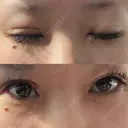目頭切開 / 眼瞼下垂（切開） サラ美容外科 DAY 8 サムネイル用