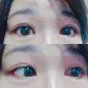 目尻切開 / タレ目形成・グラマラスライン（切開） シエルクリニック DAY 12 サムネイル用