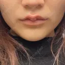 ボトックス（エラ・小顔） / ボトックス（肩） / シワ取りボトックス / ボトックス（額） BITO BEAUTY CLINIC DAY 0 サムネイル用