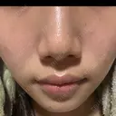 フォトRF 湘南美容クリニック 長野院 DAY 2 サムネイル用