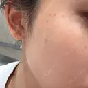 ルメッカ おおかみ美容のクリニック 新宿院 DAY 3 サムネイル用