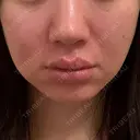 糸リフト / バッカルファット除去 / 脂肪吸引（顔） / メーラーファット除去 / ジョールファット除去 / 脂肪注入（輪郭） First Clinic DAY 14 サムネイル用