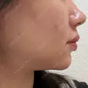 糸リフト / バッカルファット除去 / 脂肪吸引（顔） / メーラーファット除去 / ジョールファット除去 / 脂肪注入（輪郭） First Clinic DAY 14 サムネイル用