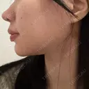 糸リフト / バッカルファット除去 / 脂肪吸引（顔） / メーラーファット除去 / ジョールファット除去 / 脂肪注入（輪郭） First Clinic DAY 14 サムネイル用