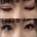 目頭切開 / 眼瞼下垂（切開） サラ美容外科 AFTER サムネイル用
