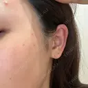 ルメッカ おおかみ美容のクリニック 新宿院 DAY 4 サムネイル用