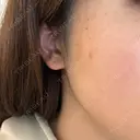 ルメッカ おおかみ美容のクリニック 新宿院 DAY 4 サムネイル用