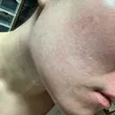 医療脱毛（顔） ZX-CLINIC 梅田院 AFTER サムネイル用