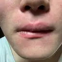 医療脱毛（顔） ZX-CLINIC 梅田院 DAY 2 サムネイル用