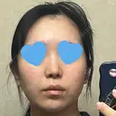 鼻尖形成（切開） / 小鼻縮小（切開） / 脂肪吸引（顔） / 軟骨移植 / 骨切幅寄せ / 鼻尖縮小 / 鼻柱挙上 銀座マイアミ美容外科 AFTER サムネイル用