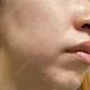 その他（肌） エースクリニック 大阪梅田HEPナビオ院 DAY 4 サムネイル用