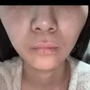 メーラーファット除去 / ハイフ（顔） A CLINIC（エークリニック） 新宿院 AFTER サムネイル用