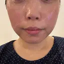 脂肪溶解注射（顔） BAO CLINIC 神戸院 DAY 0 サムネイル用